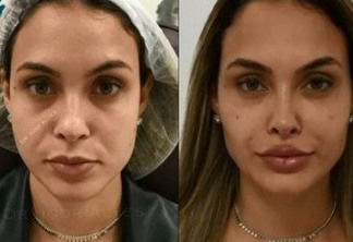 Ex-BBB Sarah Andrade faz harmonização facial com profissional que cuida de Gretchen; veja antes e depois 