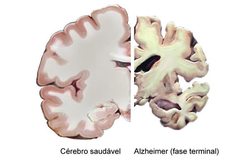 alzheimer1