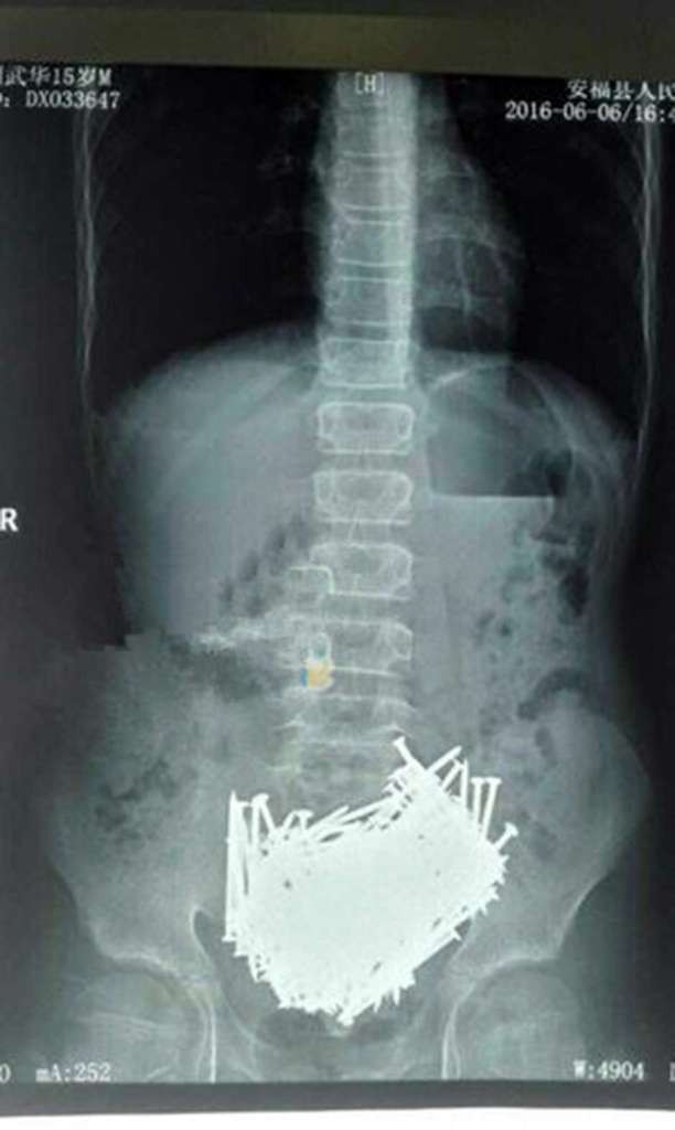 Pic shows:  CT scan of the boy’s stomach. A teenage boy in China complaining of stomach pains has had more than 200 nails removed from his body after doctors realised he had foreign objects inside his stomach. The boy reportedly swallowed metal nails, toothpicks, stones, and coins over weeks and months, with his parents unaware of what seems to be a psychological disorder. The boy, 15, identified by his surname Liu, was taken to hospital by his family members after he began to experience severe stomach and abdominal pains at their home in the township of Jintian, in Anfu County of East China’s Jiangxi Province. Doctors at a local hospital did detailed CT scans on the young patient, and found an abundance of what seemed like nails resting in the pit of his stomach. The foreign objects were lit up brightly in the scans, and doctors immediately rushed Liu into emergency surgery to remove the nails before they could cause more harm. There were also fears that the sharp nails would tear through Liu’s stomach and damage other organs. Reports said more than 200 nails were removed from Liu’s stomach, as well as objects such as wooden toothpicks, small stones, and bronze and silver coins. All in all the objects in his stomach weighed 700 grams (1.5 lbs), reports said. While Liu is now recovering after the successful surgery, it is still unclear when or why he swallowed the objects. It has been suggested that Liu may be suffering from pica - a disorder characterised by the compulsive eating of foreign objects such as hair, stones, earth, paint, metal, glass, and even faeces. (ends)